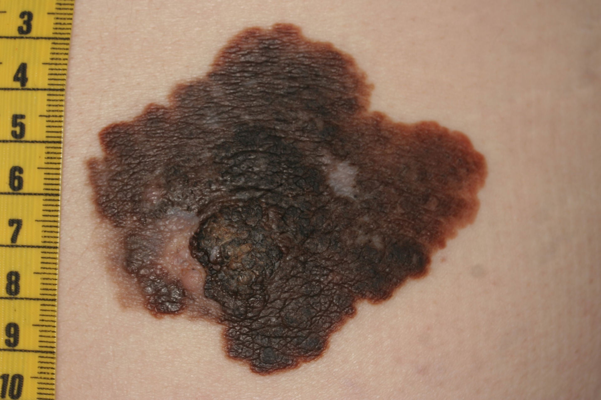 6 cm grosses Melanom, so sollte es sofort gezeigt und Ärztlich abgeklärt werden.